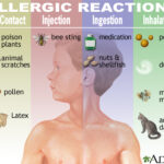 Food Allergies & Nutrition