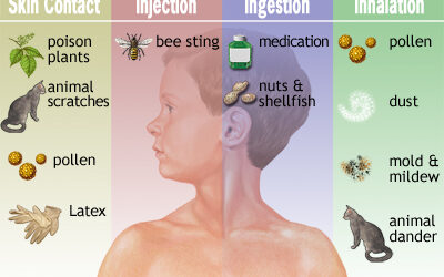 Food Allergies & Nutrition